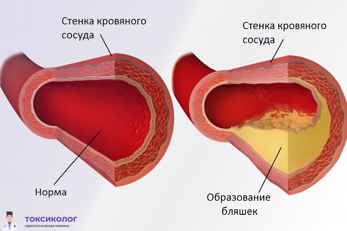 Инфографика атеросклероз