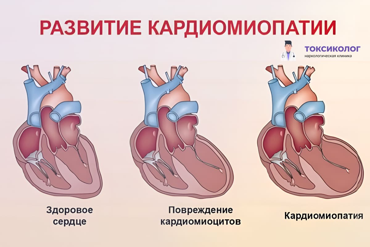 Инфографика кардиомиопатия